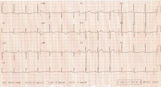 ECG of January