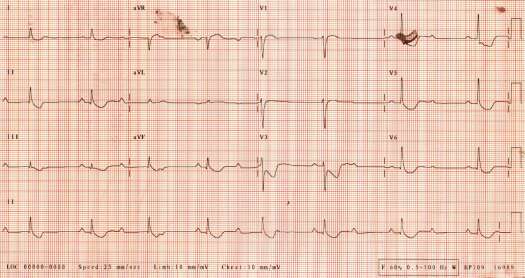 digitalis ecg