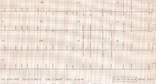  woman with rheumatic heart disease, permanent atrial fibrillation, 