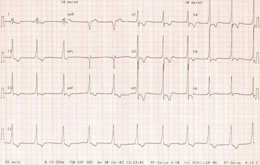 ECG of August